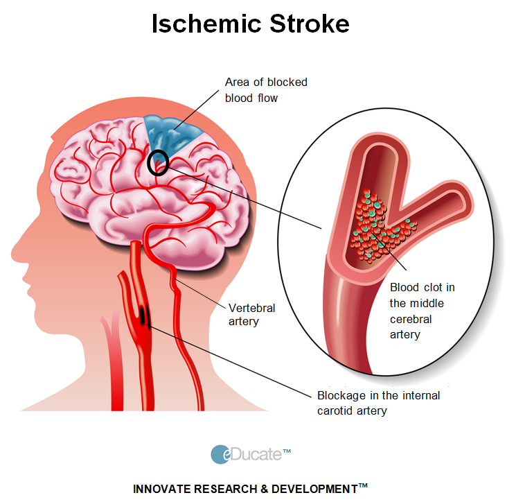 1-lightbox-ischemic stroke-cartid artery-definition.png