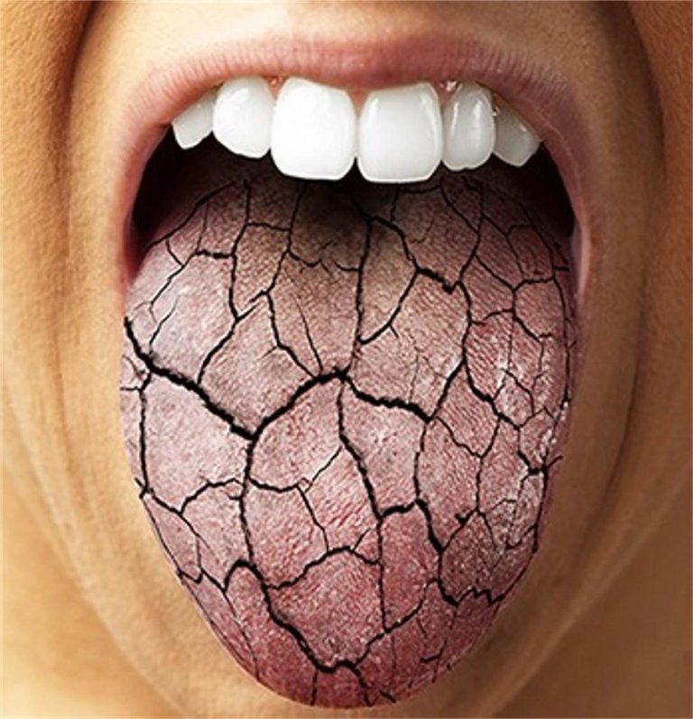 dry-mouth-987x1024.jpg