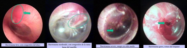 Barotraumas3-1024x265.jpg