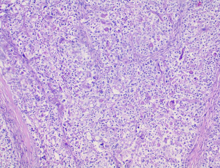 Clear Cell Carcinoma of the Ovary LPF.jpg