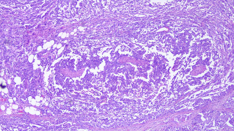 Perineural Invasion Poorly Cohesive Carcinoma Scan.png