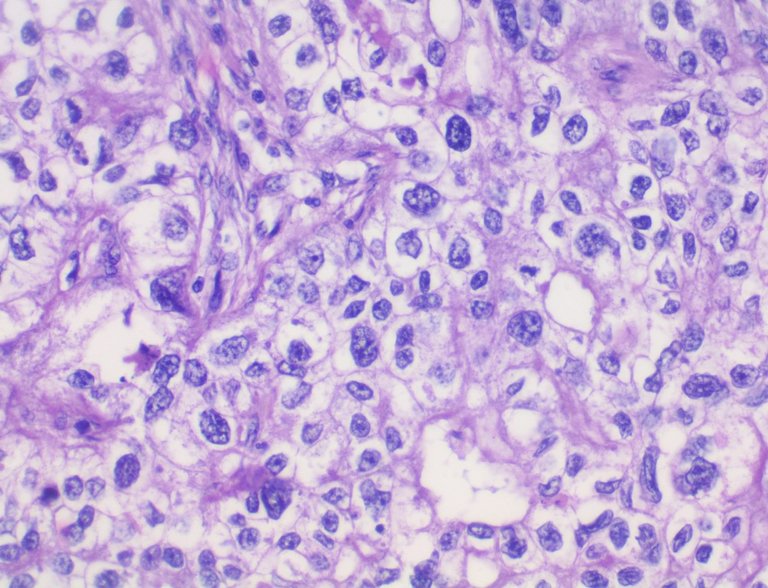Clear Cell Carcinoma of the Ovary HPF.jpg