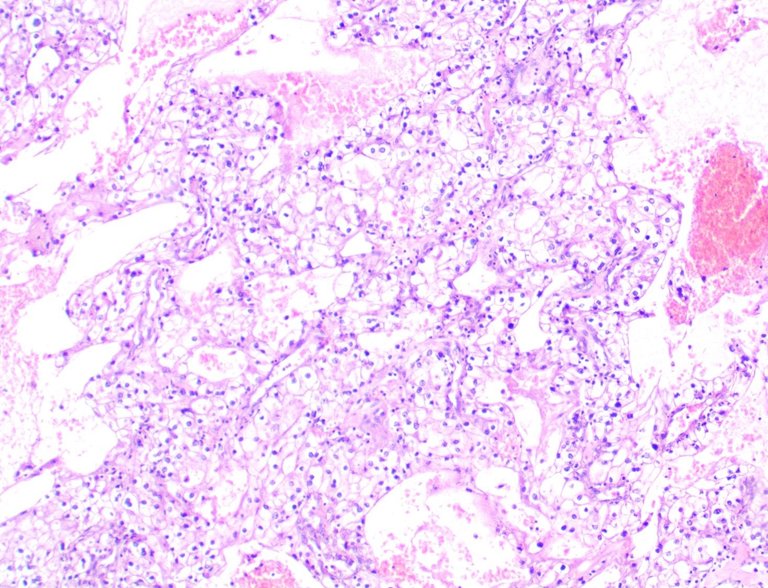 Renal Clear Cell Carcinoma LPF.jpg