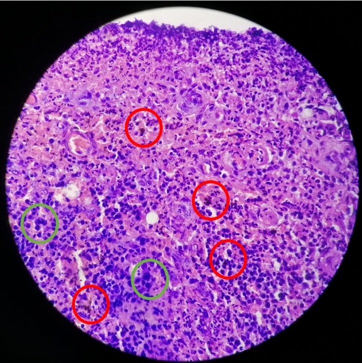 hemosiderin.jpg