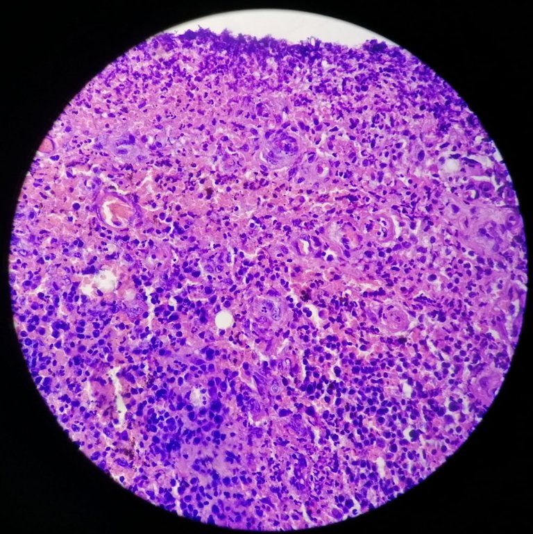 Hemosiderin laden macrophages.jpg