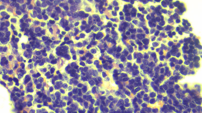 Pineoblastoma HPF 1.png