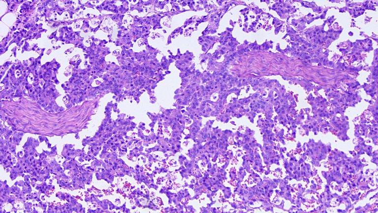Perineural Invasion Poorly Cohesive Carcinoma LPF.png