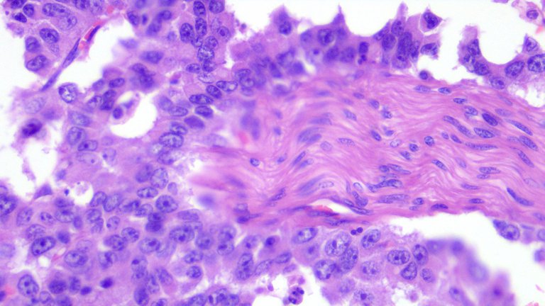 Perineural Invasion Poorly Cohesive Carcinoma HPF.png