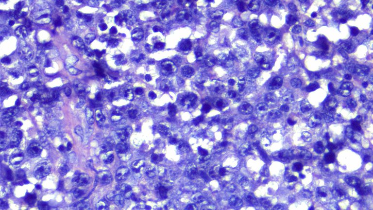 Anaplastic Large Cell Lymphoma HPF.png