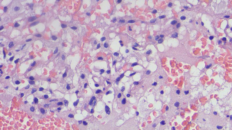 Hemangioblastoma HPF.png