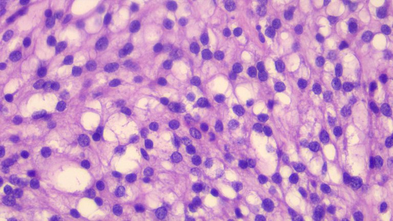 Microcystic Stromal Tumor HPF 3.png