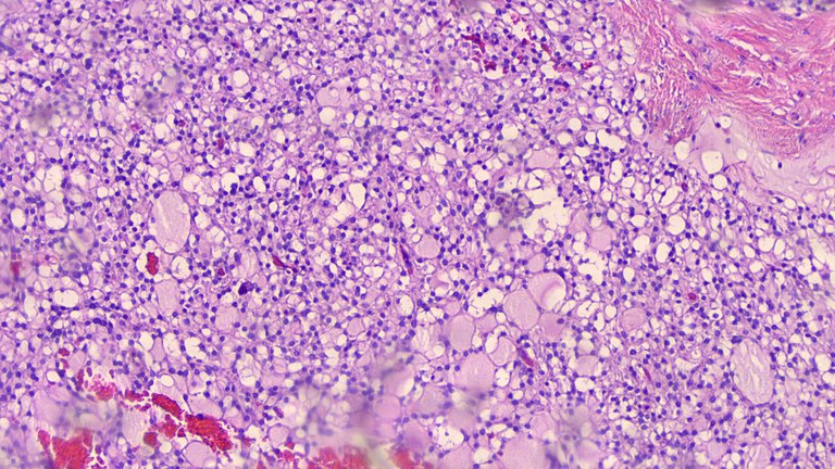 Microcystic Stromal Tumor LPF 2.png