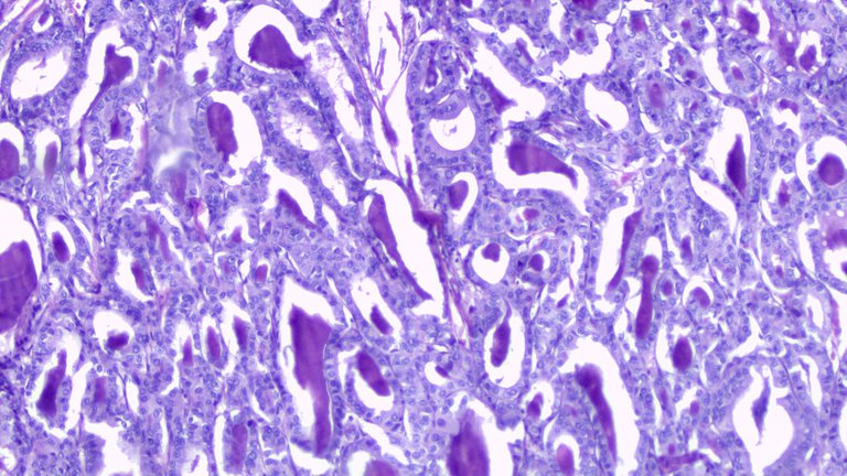 Papillary Thyroid Carcinoma LPF.png