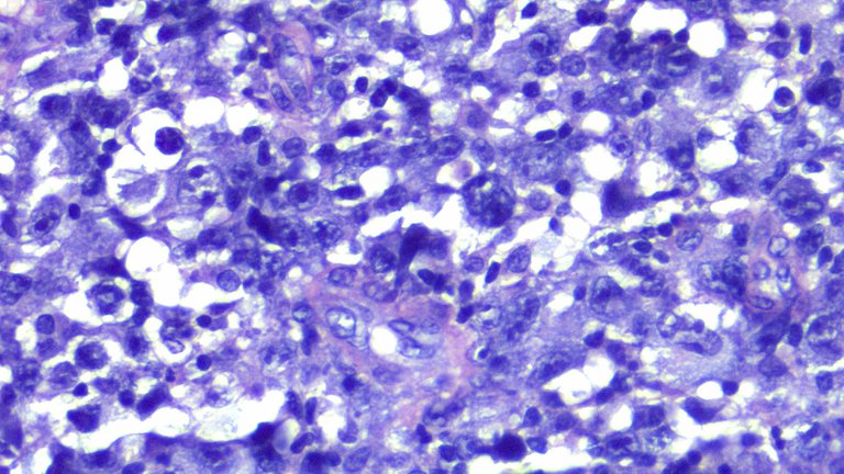 Anaplastic Large Cell Lymphoma HPF3.png