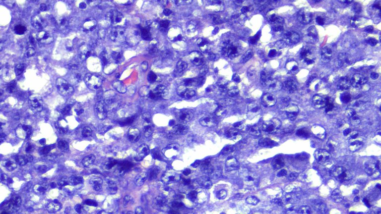 Anaplastic Large Cell Lymphoma HPF2.png