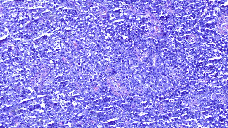 Anaplastic Large Cell Lymphoma LPF.png