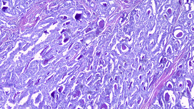 Papillary Thyroid Carcinoma Scan.png