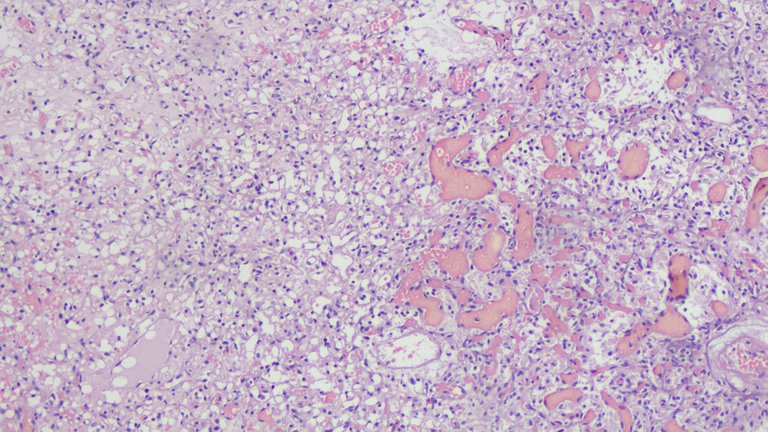 Hemangioblastoma LPF.png