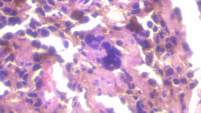 Vaginal Polyp with Malignant Melanoma HPF6.png