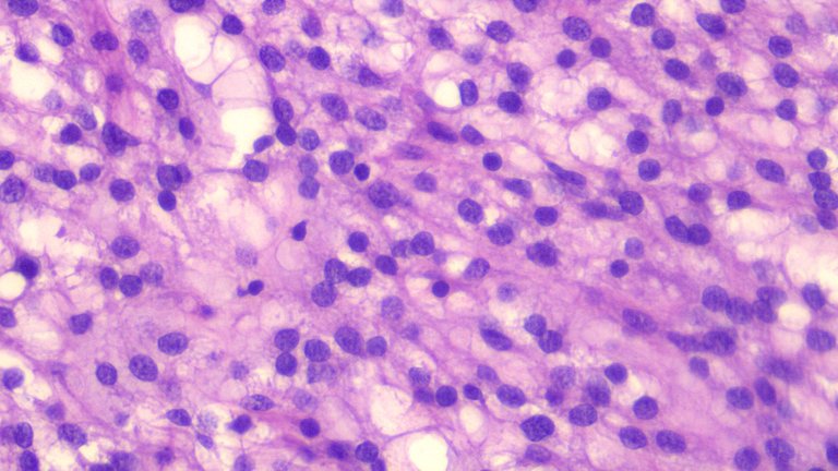 Microcystic Stromal Tumor HPF 2.png
