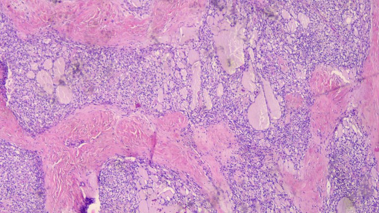 Microcystic Stromal Tumor Scanner 3.png