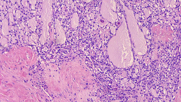 Microcystic Stromal Tumor LPF 1.png