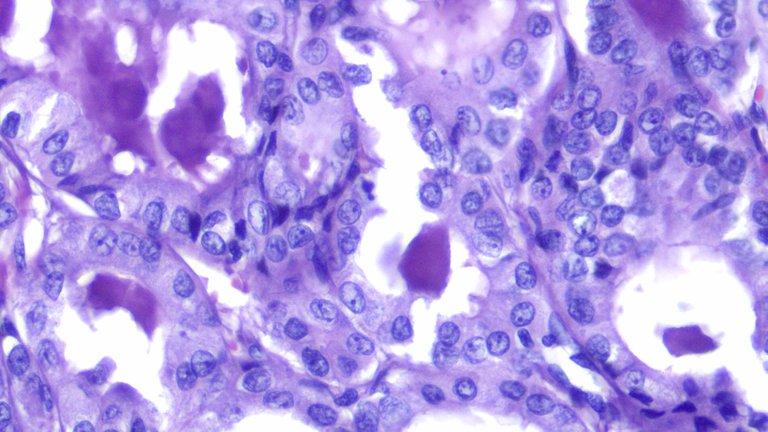 Papillary Thyroid Carcinoma HPF.png