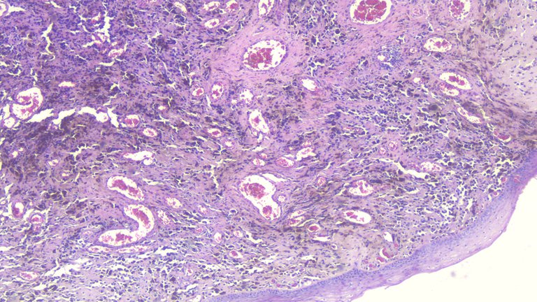 Vaginal Polyp with Malignant Melanoma Scanner.png