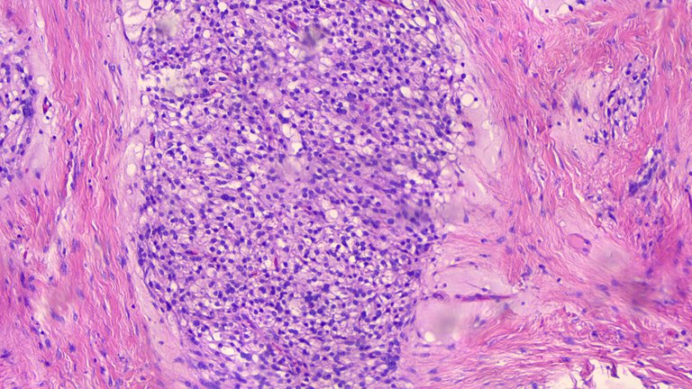Microcystic Stromal Tumor LPF 3.png