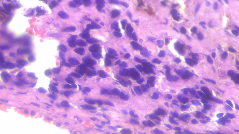 Vaginal Polyp with Malignant Melanoma HPF4.png