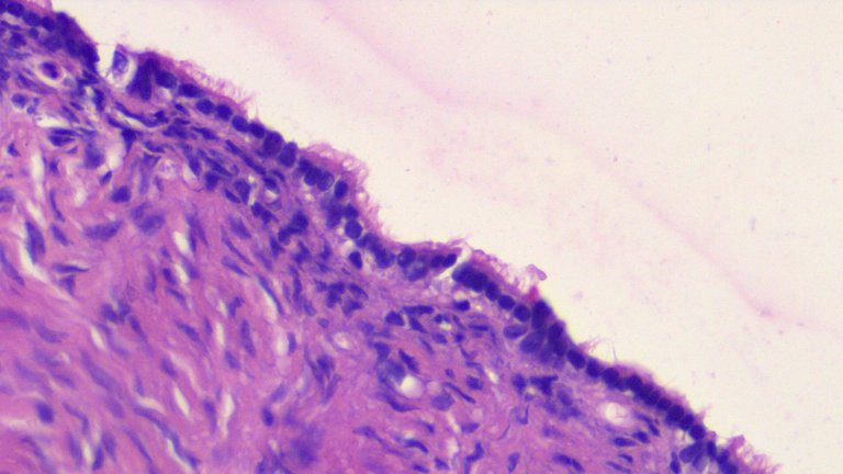 Serous Cystadenofibroma HPF.png