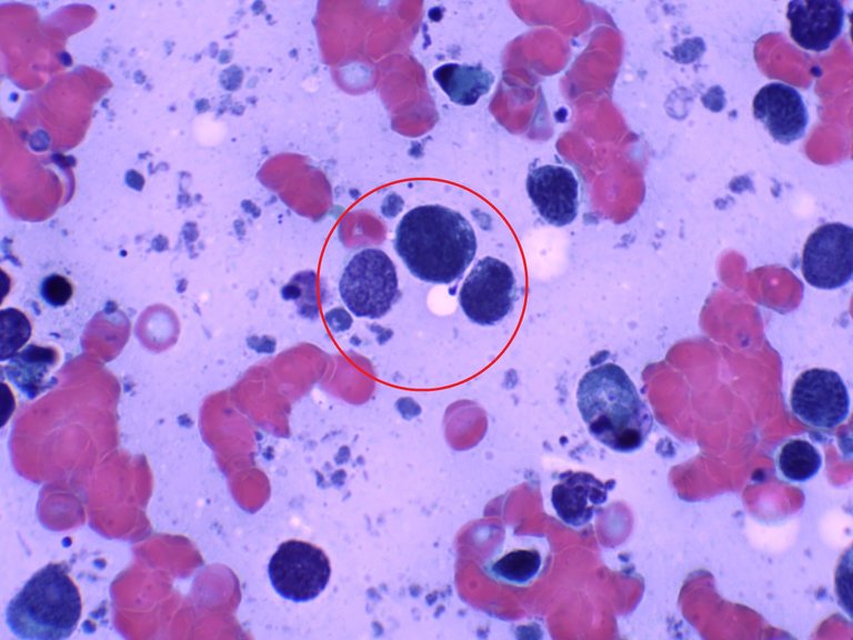 Tumor nucleoli.jpg