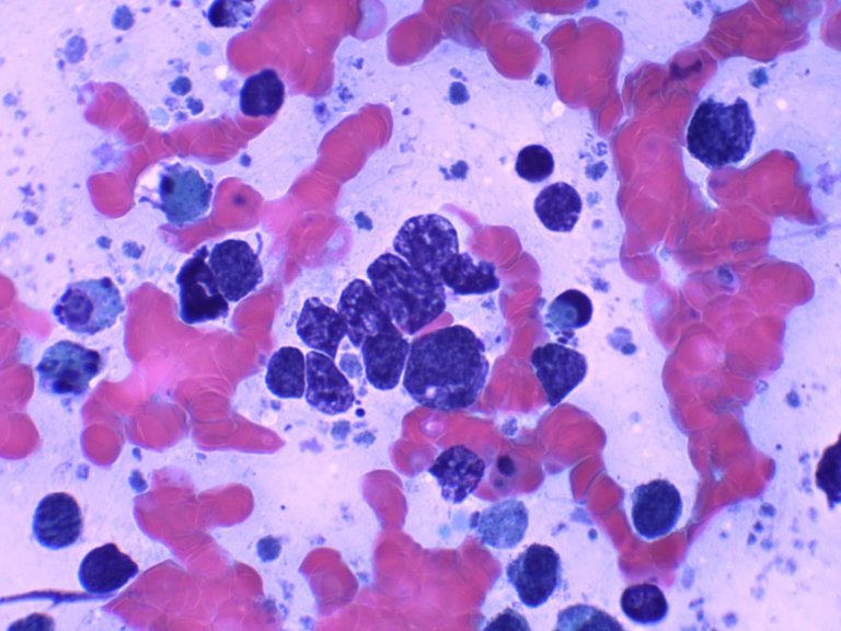 Cluster of Malignant cells.jpg
