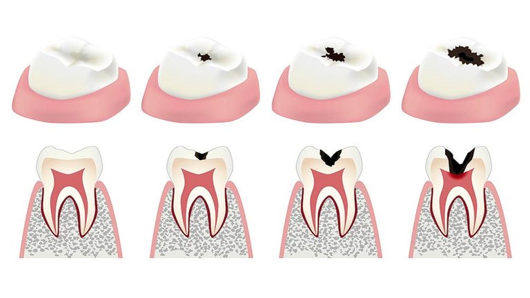 proceso-caries-dental.jpg