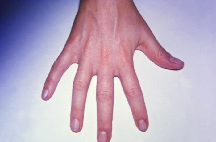 Arthritis on the Right Hand CDC Dr. Sellers, Grady Hospital 1.0 license.jpg