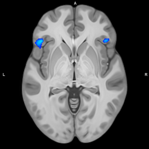 bipolar scan Petergstrom 4.0.png
