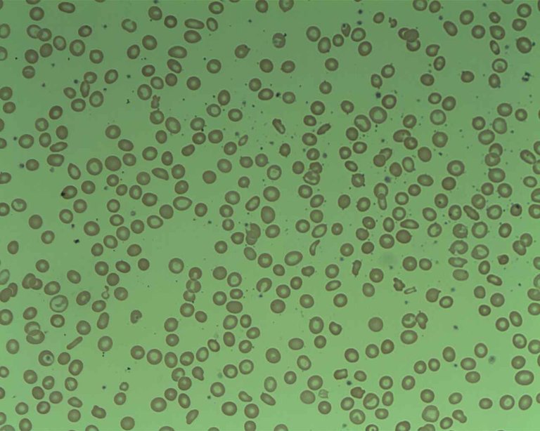 red blood cells Iron_Deficiency_7 Osaretin 4.0 0r 3.0.jpg