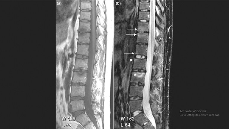 Psoriatic arthritis spine jpg credit Fiona McQueen, Marissa Lassere and Mikkel Østergaard 2.jpg