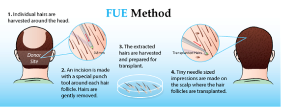 Hair_Transplant_Fue mcanhealth 4.0.png