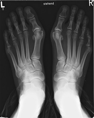 Projectional radiograph_of_bunion Michael Nebel 2.0.jpg