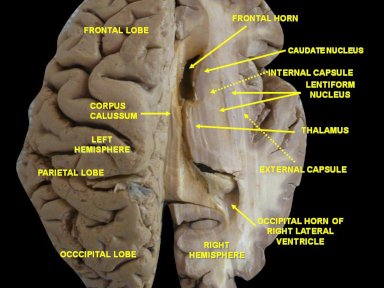 brain with parietal lobe and corpus callosum  Anatomist90 3.0.JPG