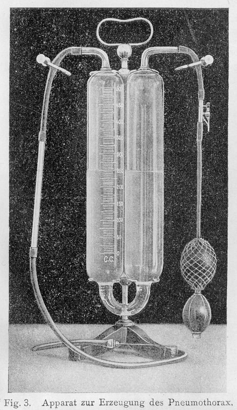 pneumothorax device Carlo_Forlanini Wellcome 4.0 credit line.jpg