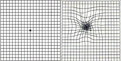 amsler grid normal and damage public.jpg