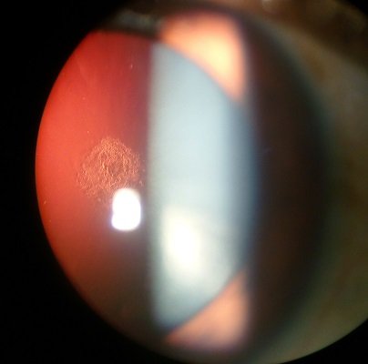 Posterior_subcapsular_cataract Imrankabirhossain 4.0.jpg