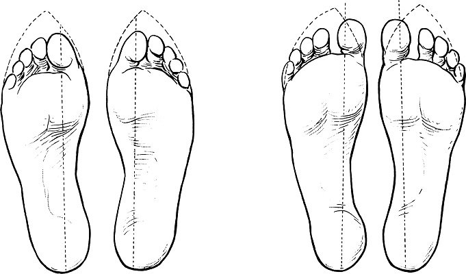 displacement of toes public.jpg
