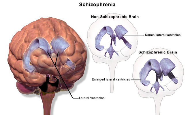 Schizophrenia Illustration BruceBlaus 4.0.png