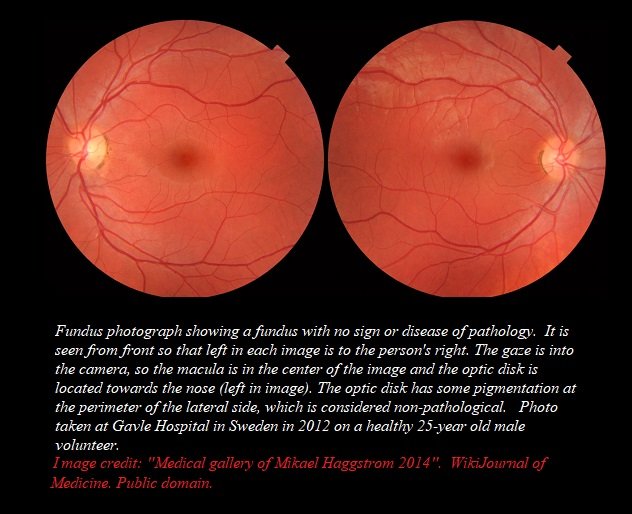 fundus photo with credit hydroxychloroquine.jpg