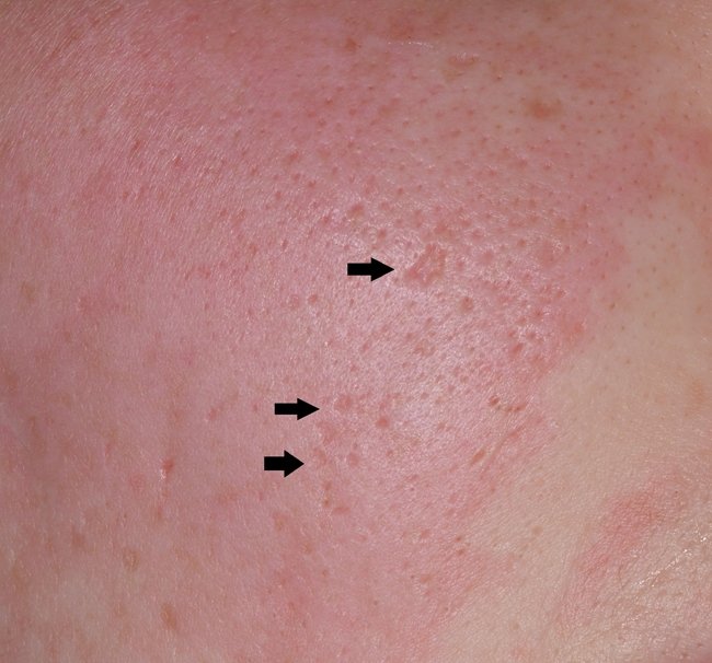 cicatrices-de-acne-en-furgon.jpg