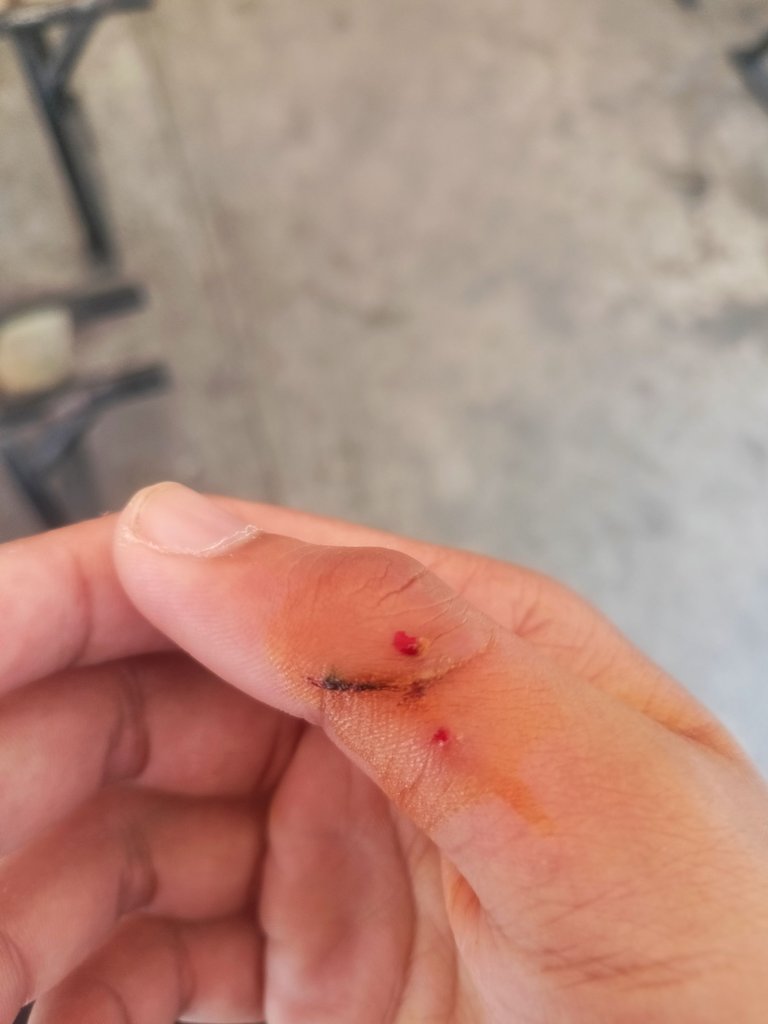 day 7 after staper removal.jpg