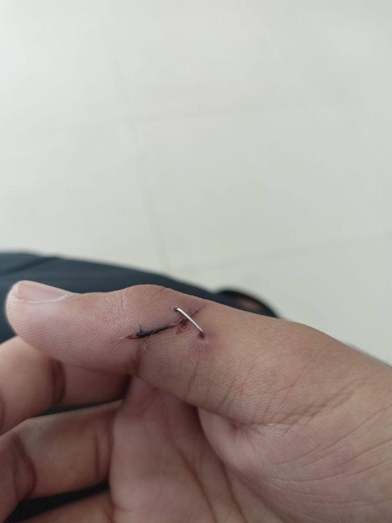 day 7 before stapler removal.jpg